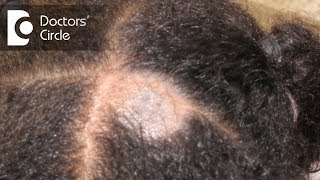 What causes Scalp Ringworm Effective Treatment   Tinea Capitis  Dr Tina Ramachander [upl. by Uhn]