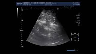 Ultrasound Video showing an Umbilical hernia [upl. by Nirehtac]