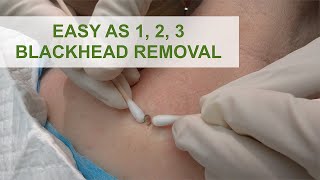 Easy as 1 2 3 Blackhead Removal  Dr Derm [upl. by Longmire690]